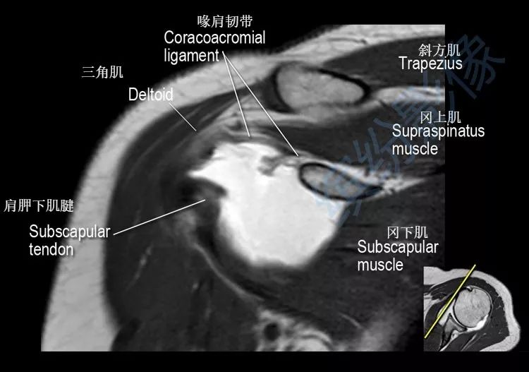 肩关节斜冠状面mr断层解剖