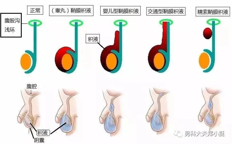 男性科普阴囊肿大可能是鞘膜积液惹的祸