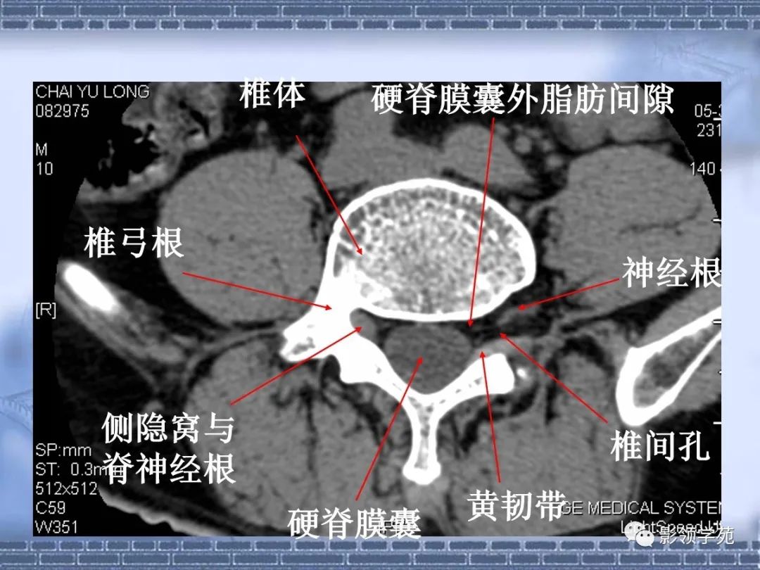 颈椎,腰椎ct常见病变