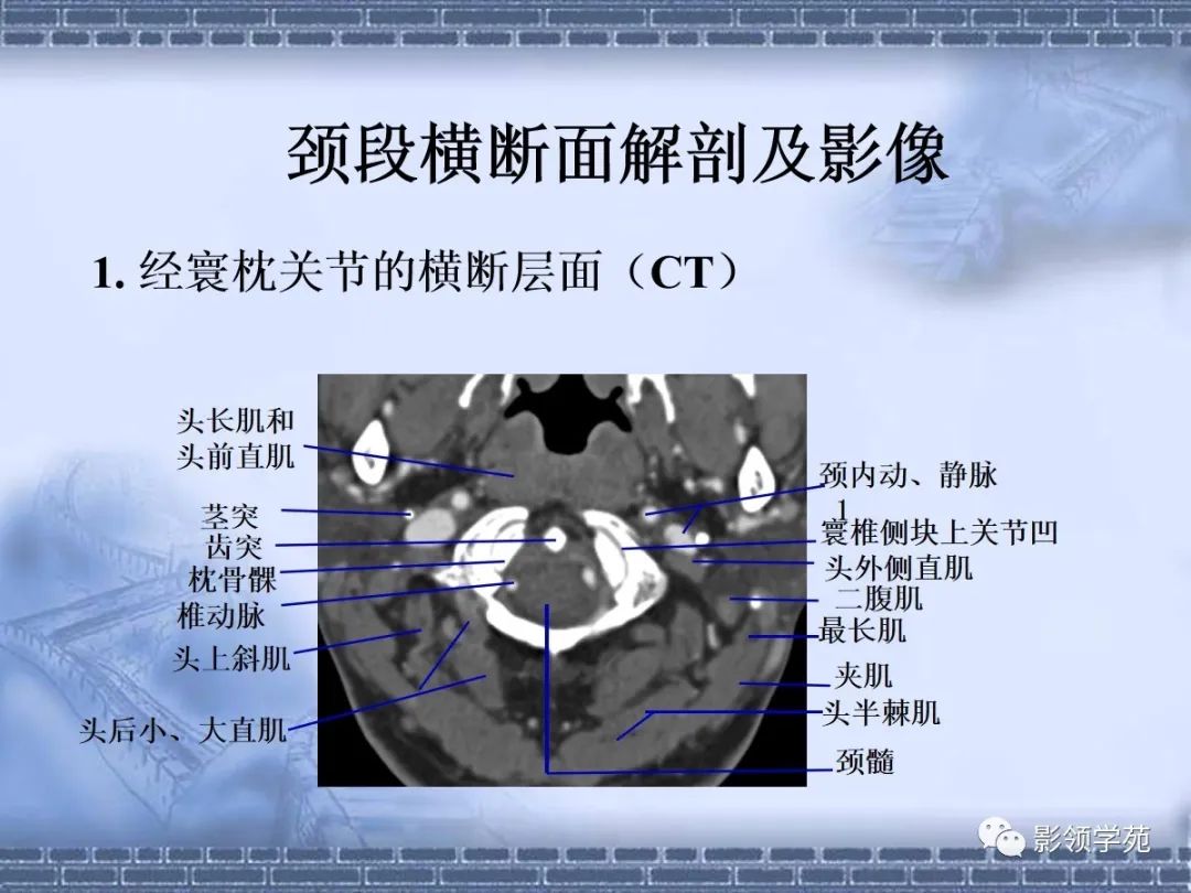 颈椎腰椎ct常见病变