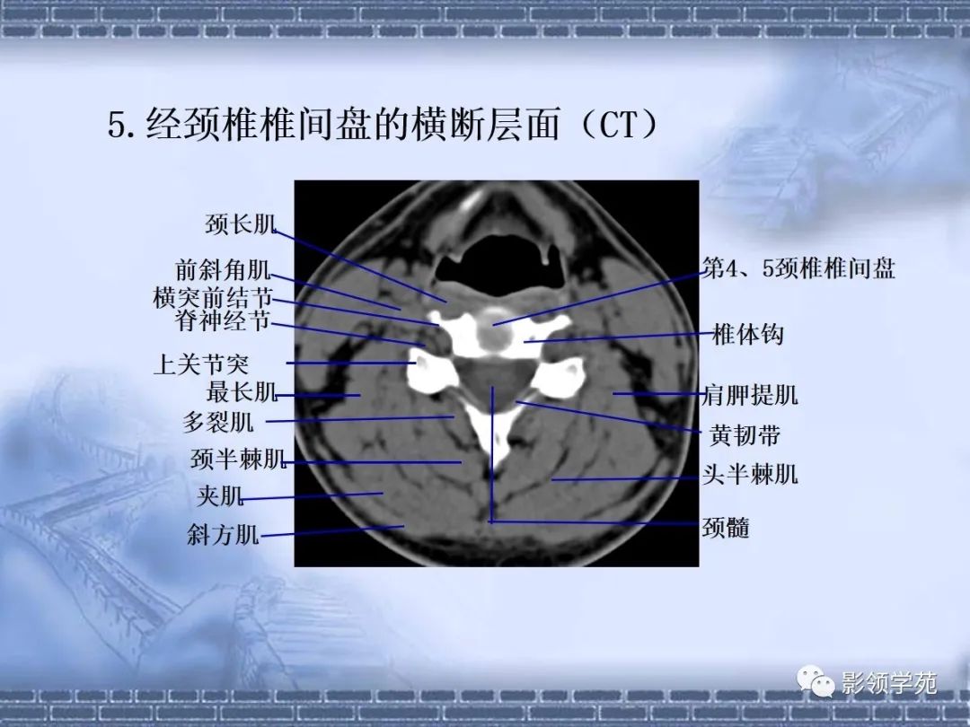 颈椎腰椎ct常见病变