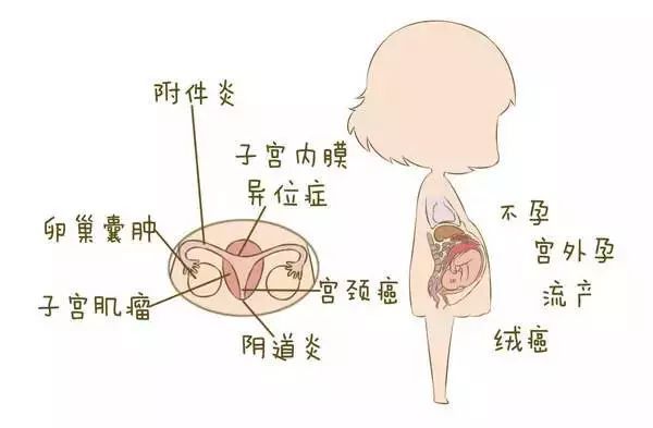 不孕不育头号杀手:子宫内膜异位症