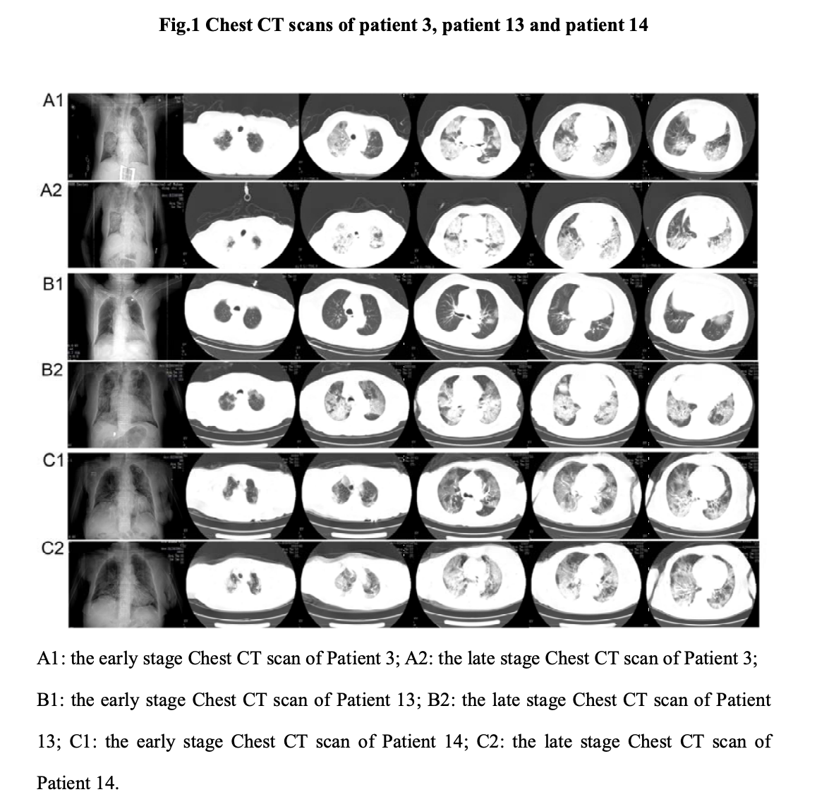 25例新冠肺炎死亡患者临床分析：因肺部黏液过多