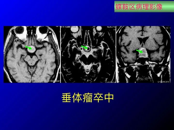 实用课件| 鞍区解剖资料