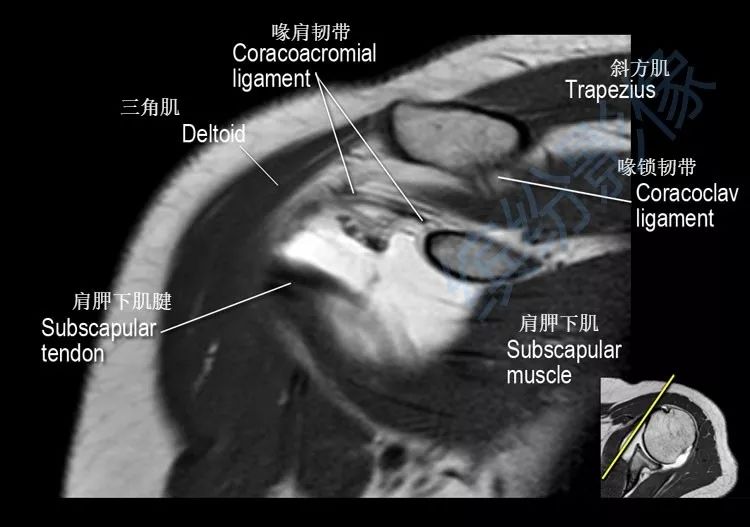 肩关节斜冠状面mr断层解剖