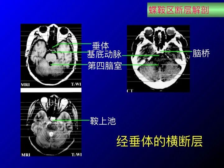 实用课件鞍区解剖资料