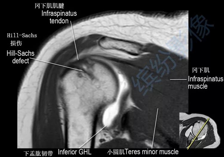 肩关节斜冠状面mr断层解剖