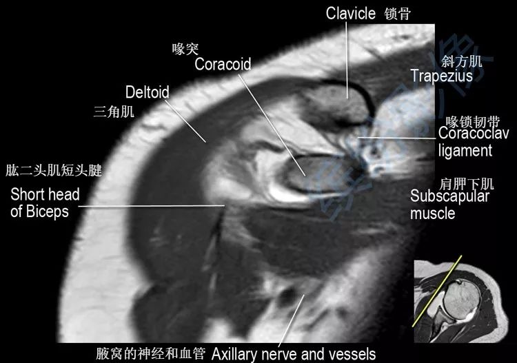 肩关节斜冠状面mr断层解剖