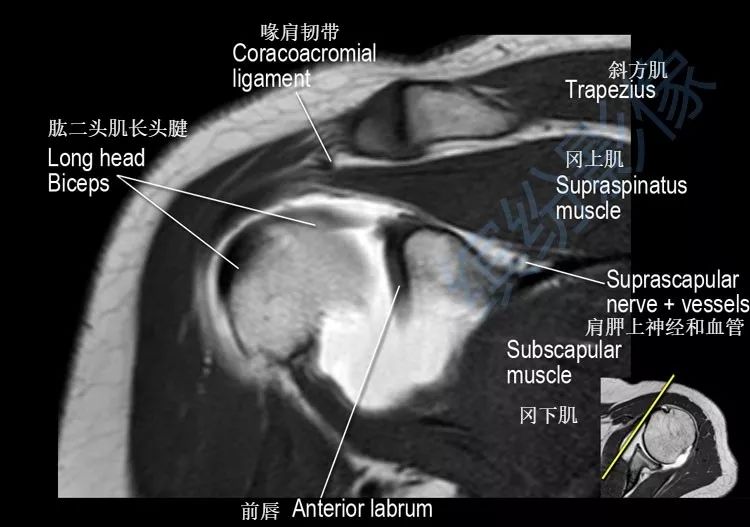 肩关节斜冠状面mr断层解剖