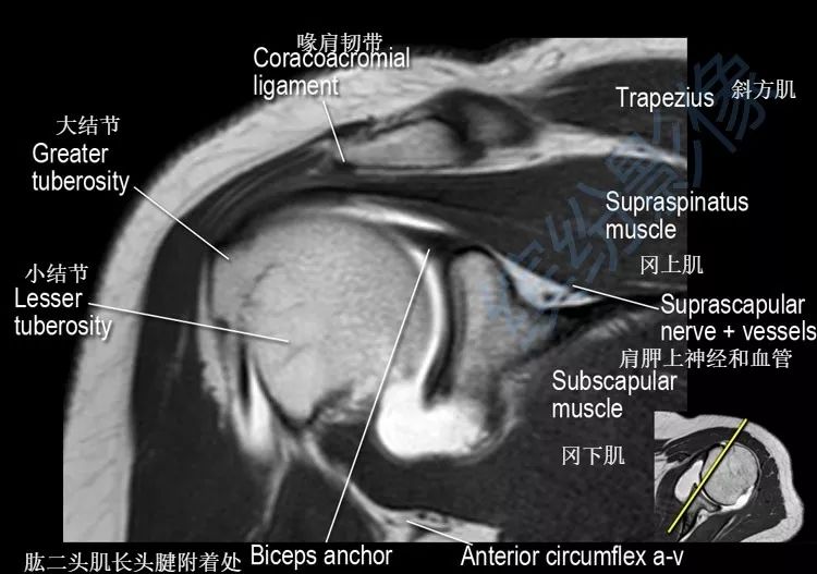 肩关节斜冠状面mr断层解剖