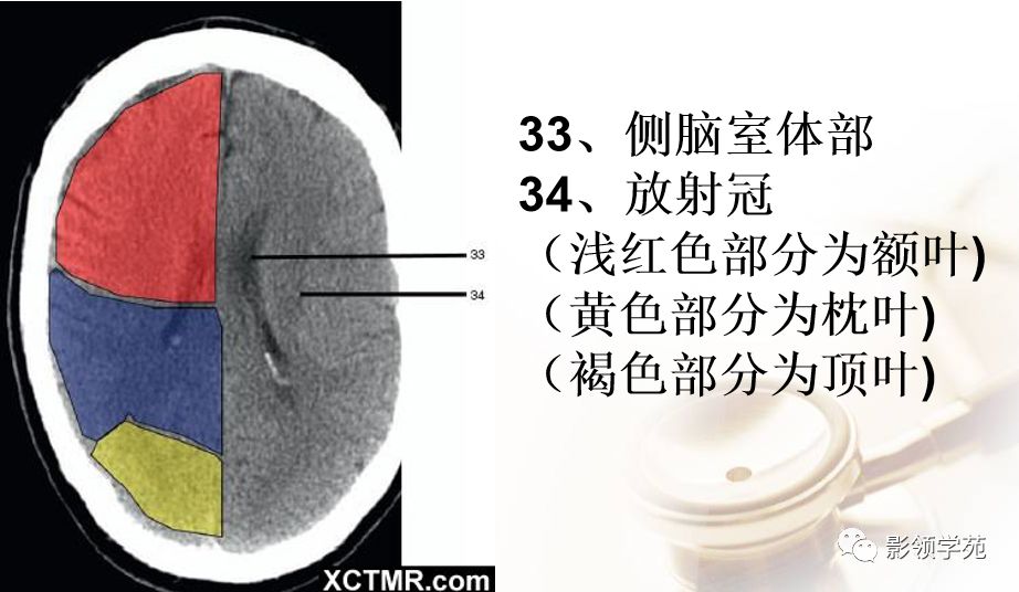脑实质ct断层解剖_白质