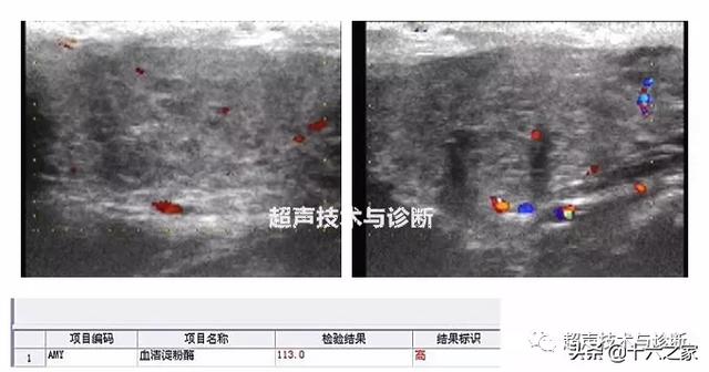 流行性腮腺炎,超声表现是怎样的?