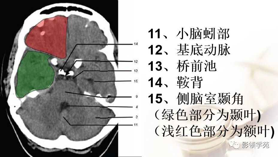 脑实质ct断层解剖_白质