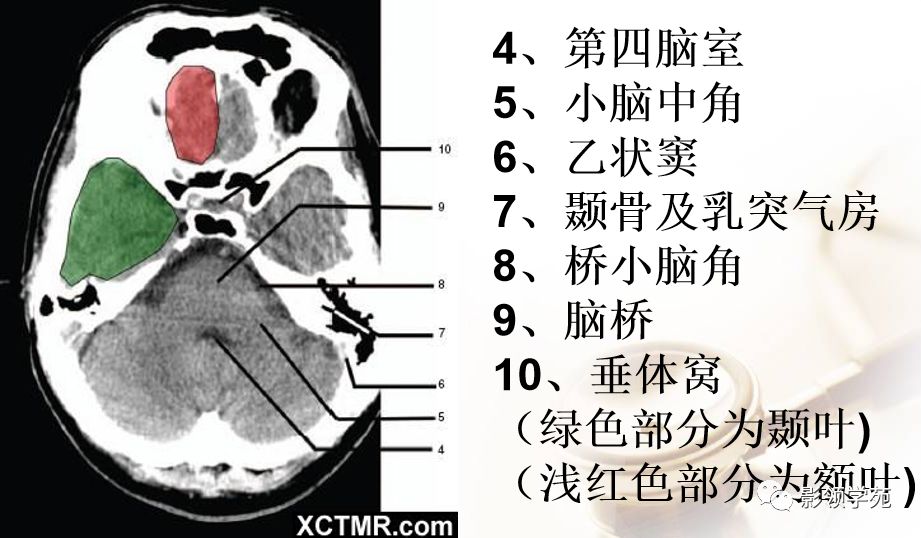 脑实质ct断层解剖