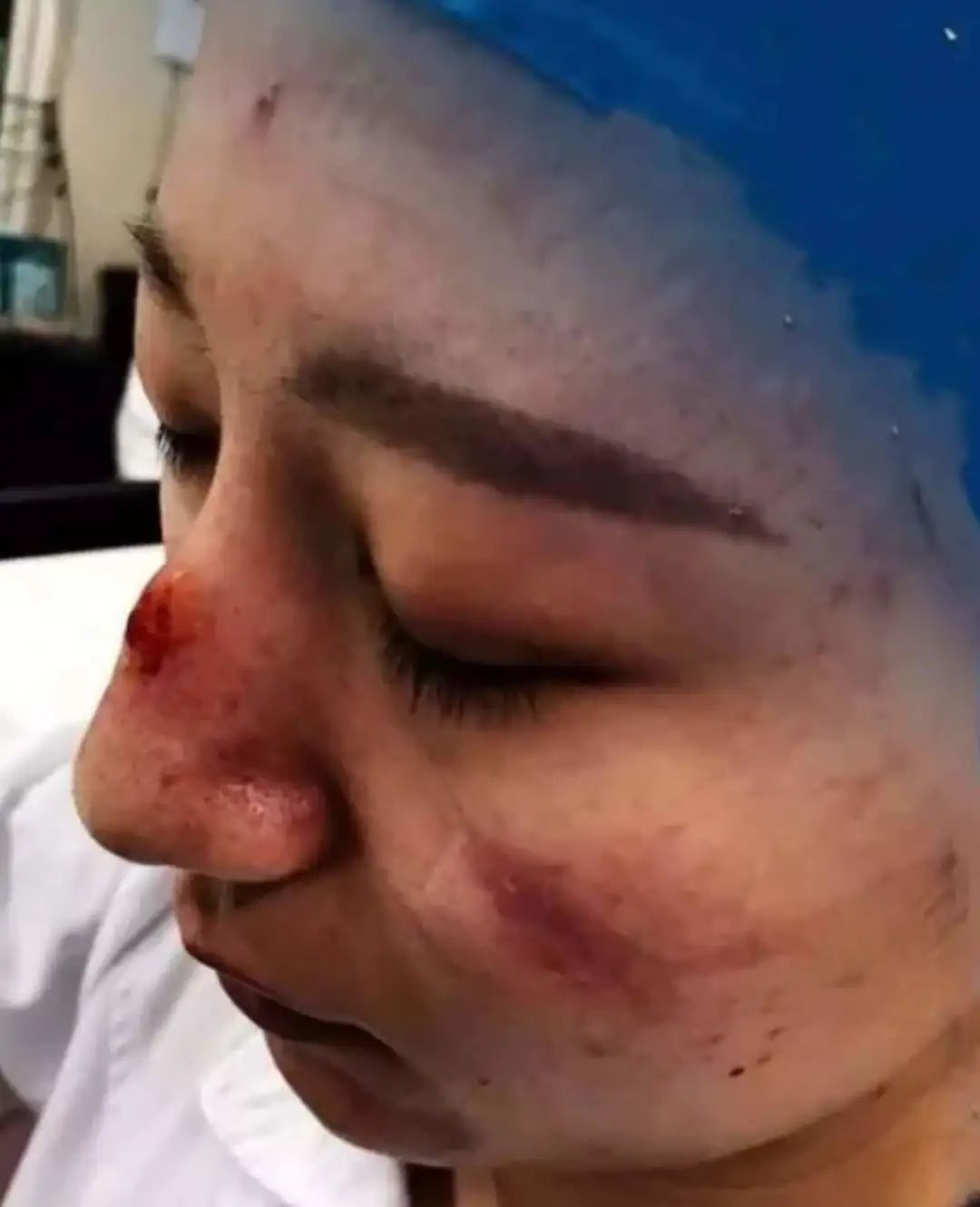 【科普】手部过敏皴裂,皮肤压伤起痘怎么办?皮肤科医生支招啦