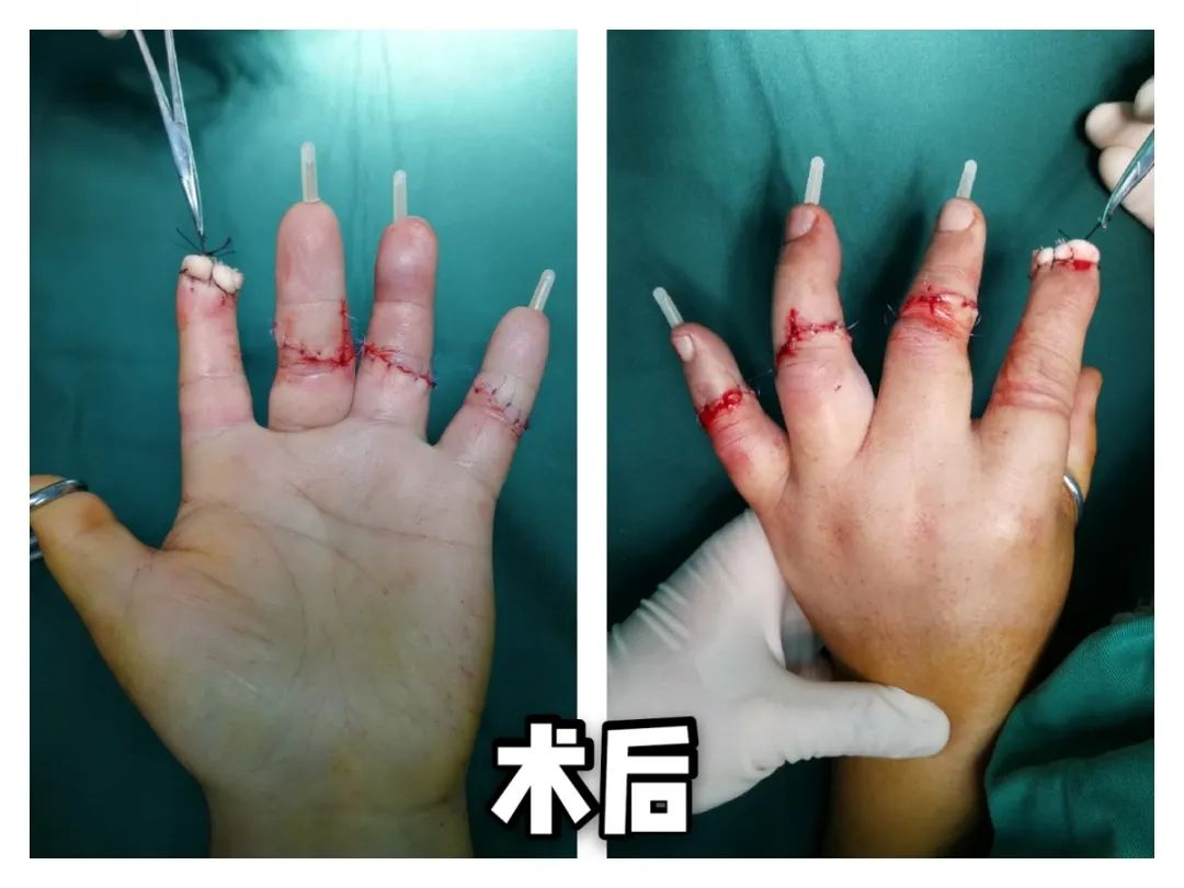 滨州一男子剁骨头时,砍下自己四根手指!
