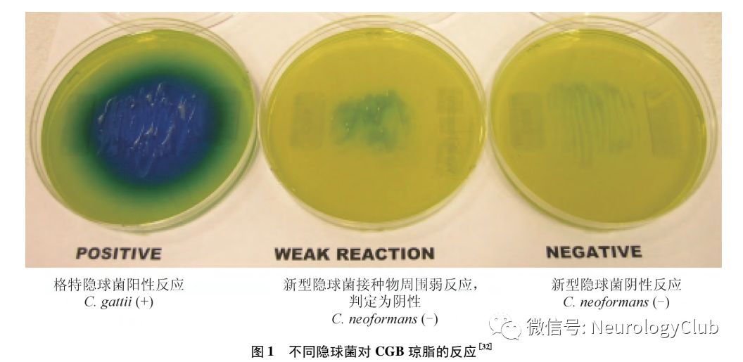 神经综述格特隐球菌性脑膜炎的临床特征和实验室检查研究进展