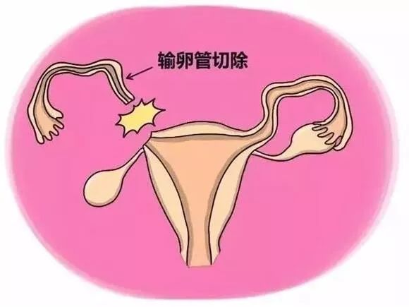 单侧输卵管堵塞会影响女性自然受孕吗