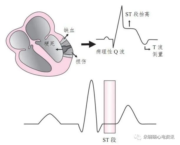 ① st段抬高呈弓背向上型,在面向坏死区周围心肌损伤区的导联上出现