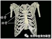 病因其病因包括以下四个方面①第一肋骨畸形,正常的第一肋骨向前向下