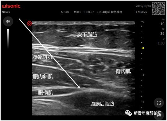 实用技术超声引导腹横肌平面阻滞和腰方肌阻滞