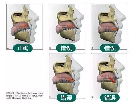 老年人口呼吸矫正_牙齿矫正图片