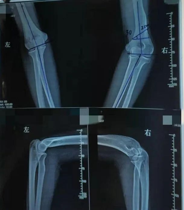 小时摔伤致肘内翻畸形,矫形术小切口恢复正常!