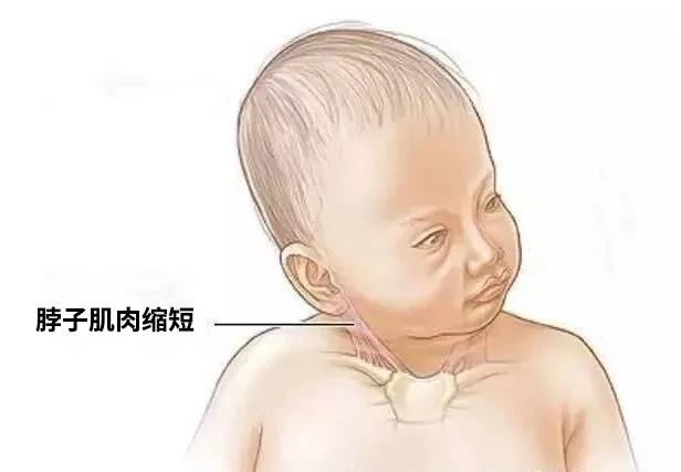 抱姿不对，可能导致宝宝“歪脖子”！快看你抱对了吗？