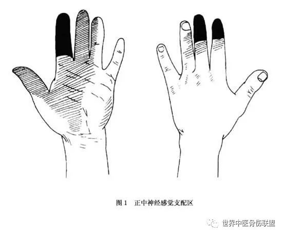 正中神经麻痹_损伤