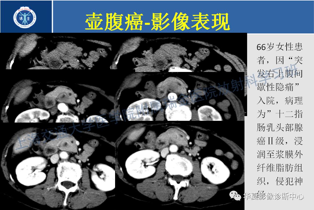 壶腹部癌的影像诊断_附属