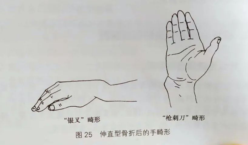 【骨科康复】桡骨远端骨折的康复干货分享