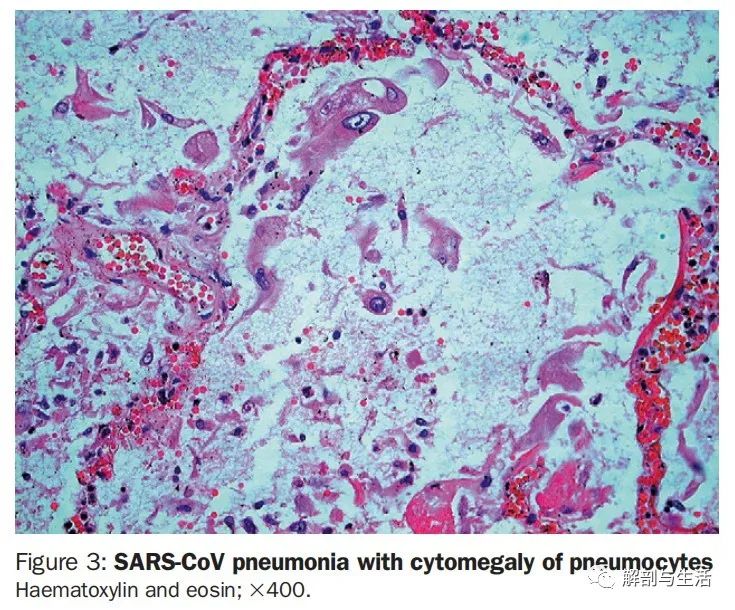 sars表现为透明膜形成和肺细胞脱落伴局灶性巨细胞形成,he,x400