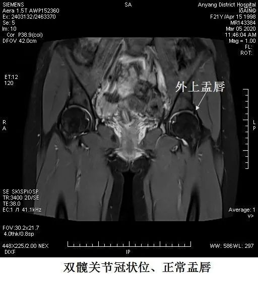 安阳地区医院磁共振专家提醒您髋部疼痛有可能是盂唇损伤