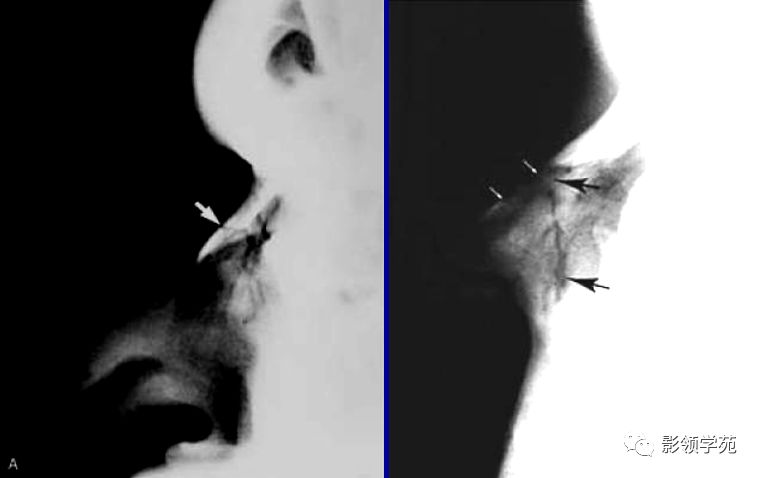 骨折鼻中隔骨折诊断临床x线初查hrct可靠鉴别诊断鼻缝鼻骨孔缝间骨鼻