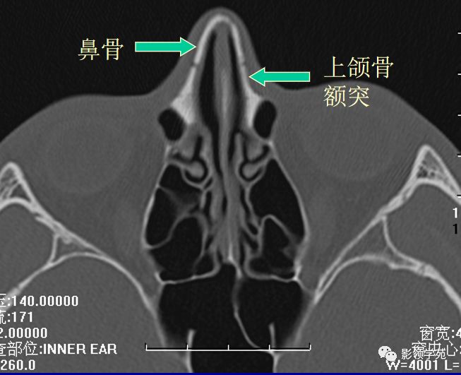 压痛 检查方法 x线平片:侧位 hrct 横断面: 听眶下线 冠状面: 鼻骨长