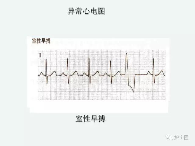 心电监护仪怎么看数值视频 8bc8257a94f44fce89220a63fc41706c.jpeg