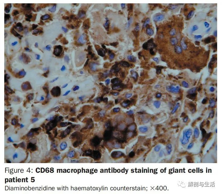 患者5巨细胞cd68巨噬细胞抗体染色(dab苏木素复染),x400