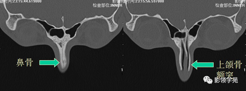 鼻骨横断面hrct鼻骨正常侧位层厚:1～2mm冠状面