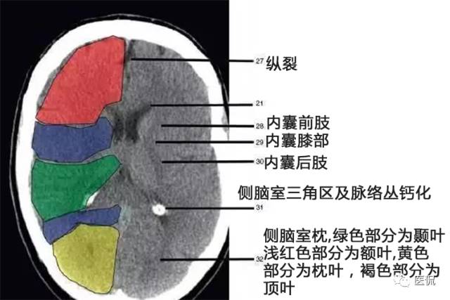 颅脑ct解剖口诀及彩色解剖图