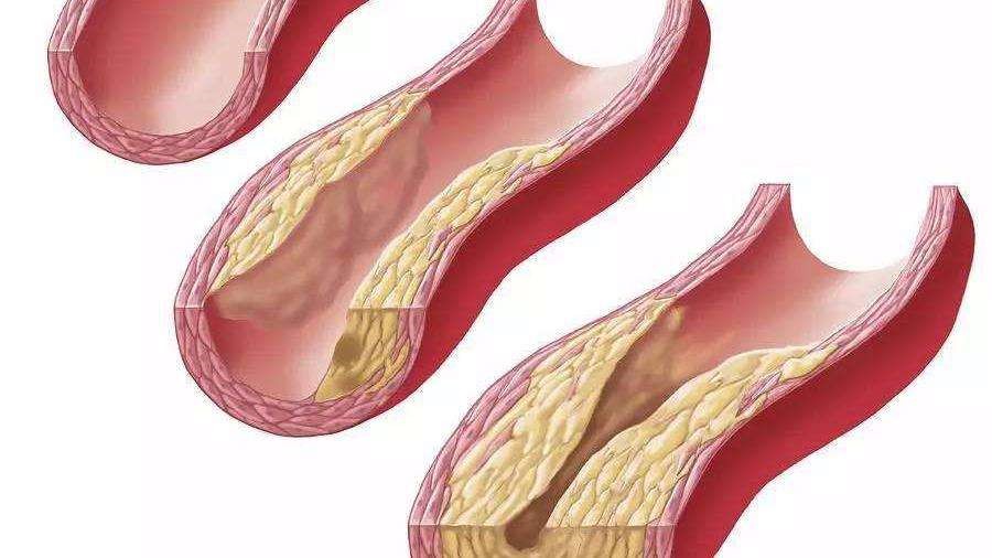 但是如果产生了斑块使得血管越来越细,则形成了动脉硬化,无法恢复