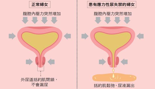 女性压力性尿失禁有没有预防治疗的办法?