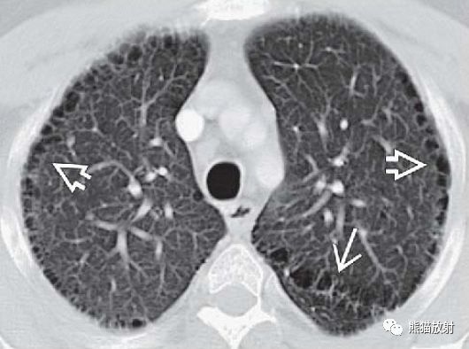 全小叶型间隔旁型肺气肿丨ct诊断要点