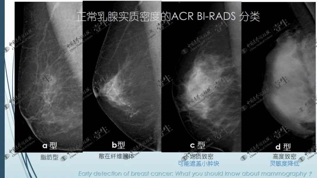 掌握乳腺影像诊断,超声,钼靶,核磁一个也不能少