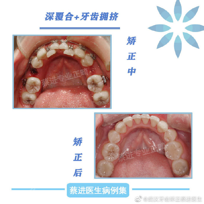 武汉牙齿矫正蔡进医生:深覆合 牙齿拥挤正畸病例