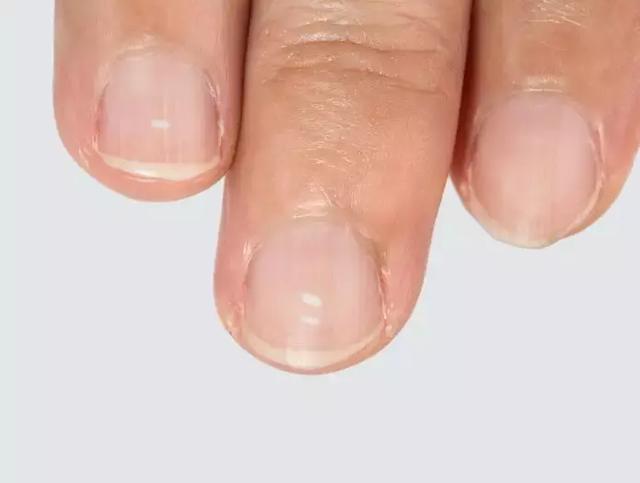 指甲变这样,不是大病就是癌!月牙,白点,竖线,到底代表