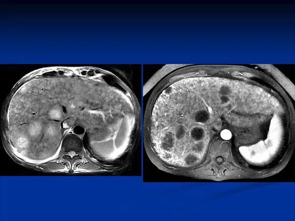 肝脏病变的mr诊断