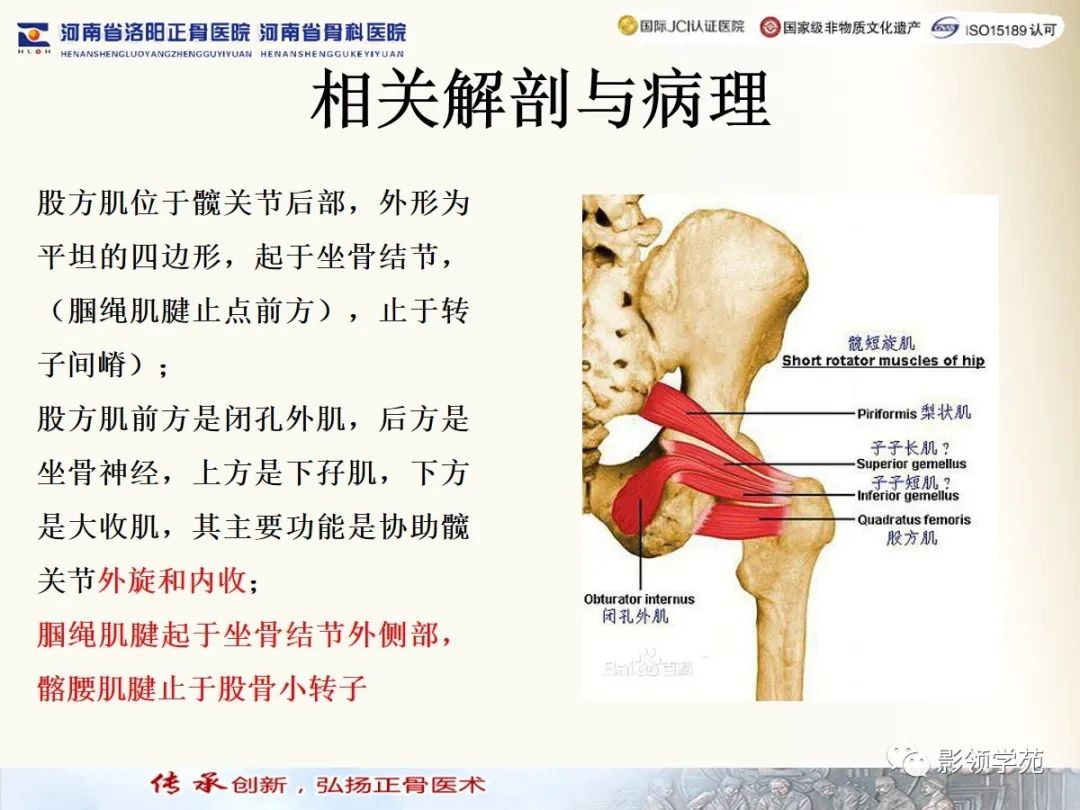 经典坐骨股骨撞击综合征