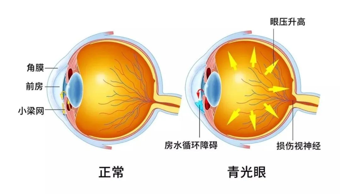 世界青光眼周|青光眼致盲不可逆,五大类人群需注意!