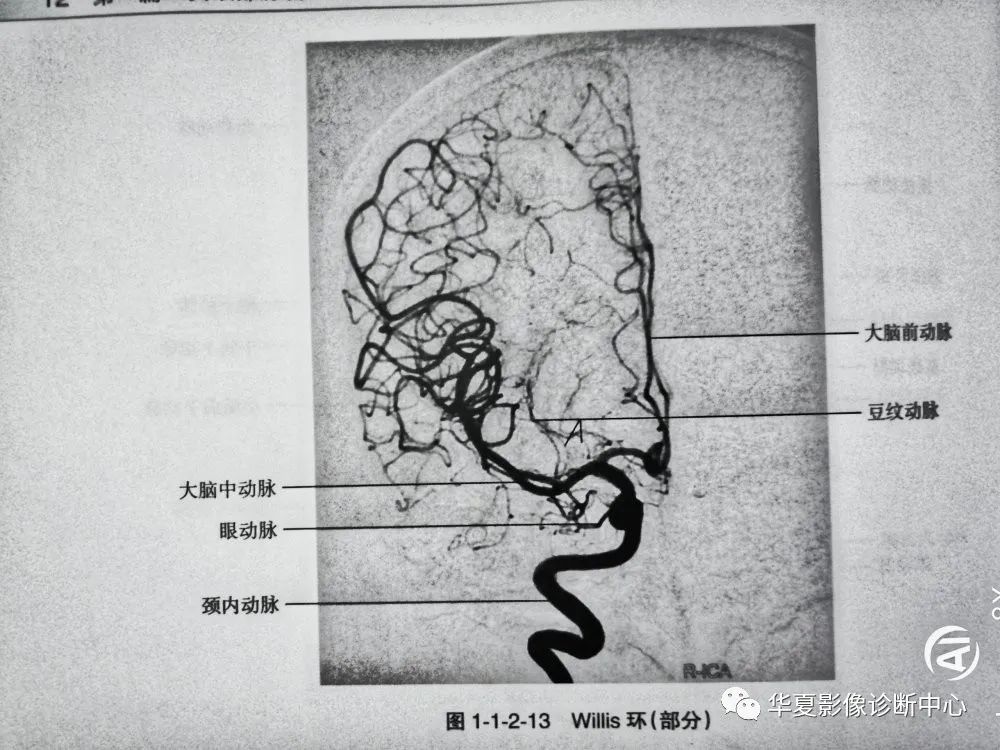 数字减影血管造影dsa下头部二三级动脉血管解剖影像下载保存