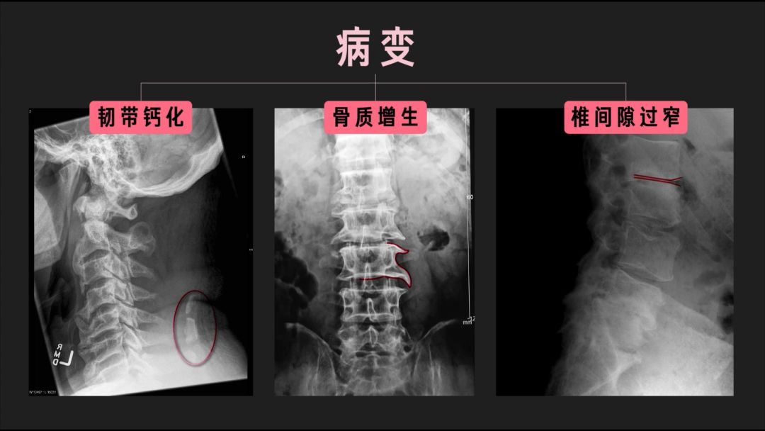 不论颈椎,腰椎,曲度变直都可能伴随其他病变,比如韧带钙化,骨质增生